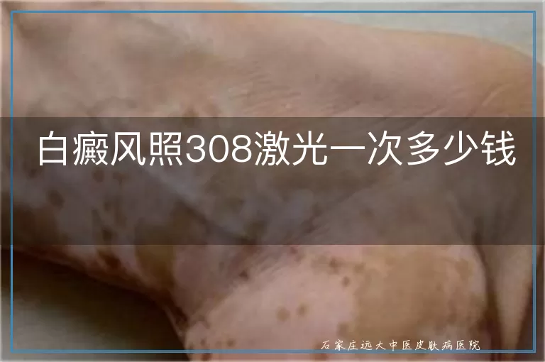 白癜风照308激光一次多少钱