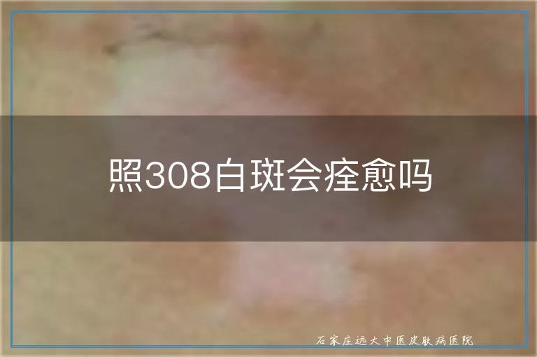 照308白斑会痊愈吗