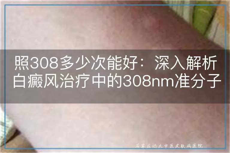 照308多少次能好：深入解析白癜风治疗中的308nm准分子激光疗法