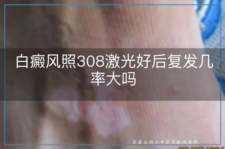 白癜风照308激光好后复发几率大吗