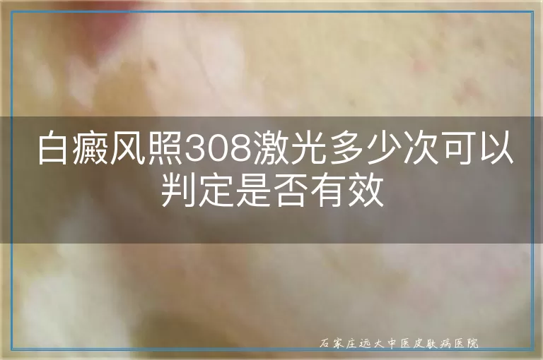 白癜风照308激光多少次可以判定是否有效