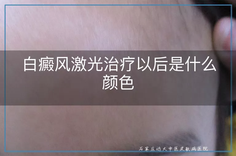 白癜风激光治疗以后是什么颜色