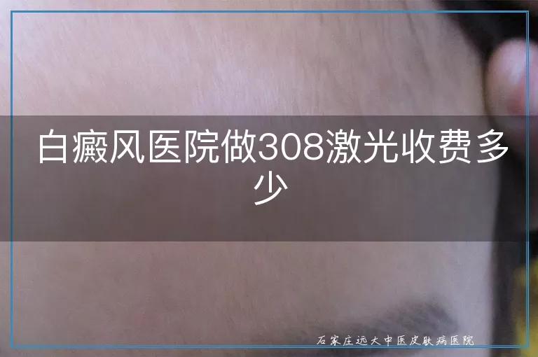 白癜风医院做308激光收费多少