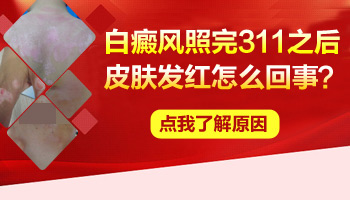 4个月孩子手上有白块用伍德灯诊断为白癜风依据是什么